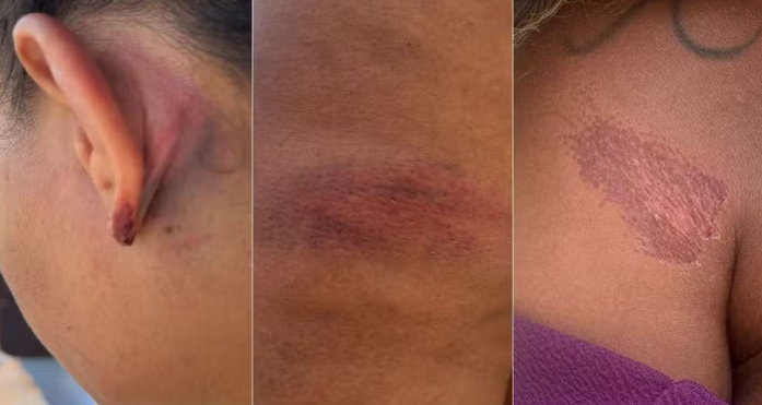 Advogada ficou com várias marcas da violência no corpo (Fotos: Iara Nóbrega/Inter TVCabugi)