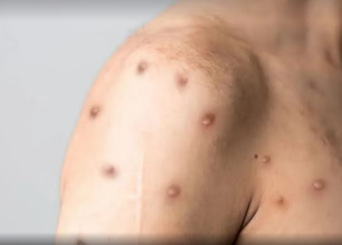 Monkeypox tem vários casos no país (Reprodução do G1)